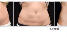 Best Tummy Tuck