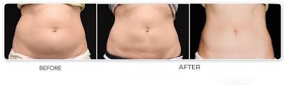 Best Tummy Tuck