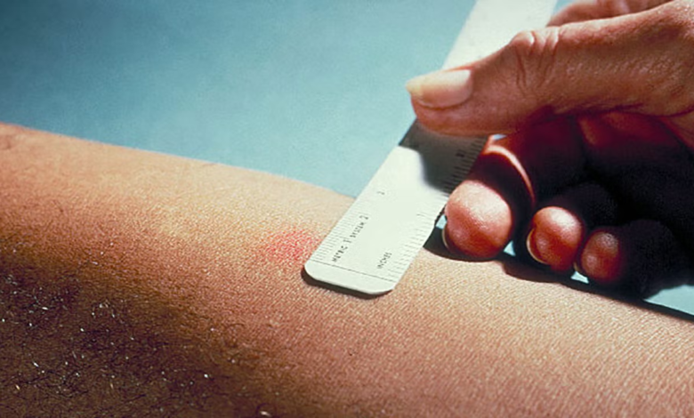How TB Skin Test and Vaccines Can Make Traveling Safer